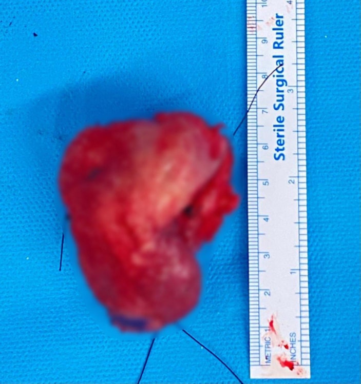 İstanbul'da, kırık dişi dil kanseri olmasına neden oldu