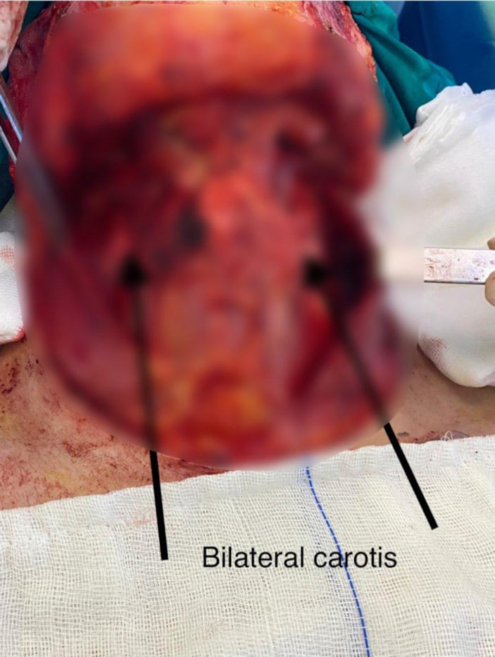 İstanbul'da, kırık dişi dil kanseri olmasına neden oldu
