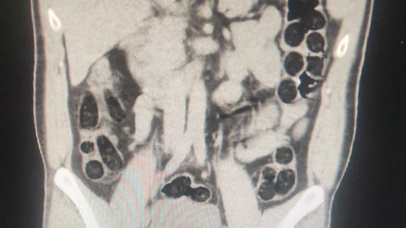 Batman'da İranlı yolcunun midesinden eroin çıktı