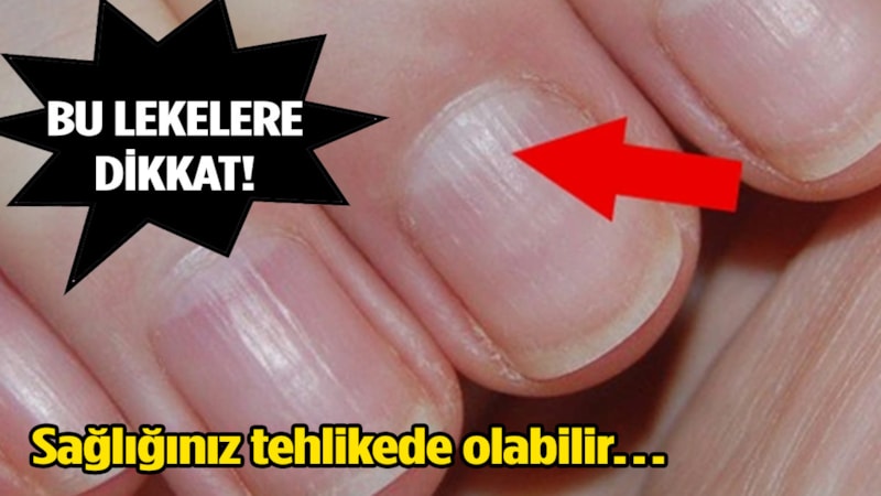 Tırnağınızda bu yarım daire yoksa dikkat! Bu sağlık sorunlarına işaret ediyor…