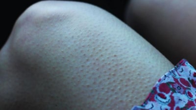 Aknesiz ve pürüzsüz bir cilt mümkün: Tavuk derisi sorunu nasıl geçer?