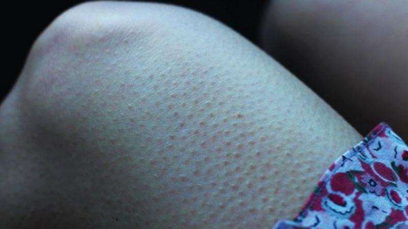 Aknesiz ve pürüzsüz bir cilt mümkün: Tavuk derisi sorunu nasıl geçer?