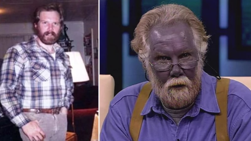 İlaçla Şirin Baba'ya dönüştü! Mavi deri hastası Paul Karason'un inanılmaz hikayesi...