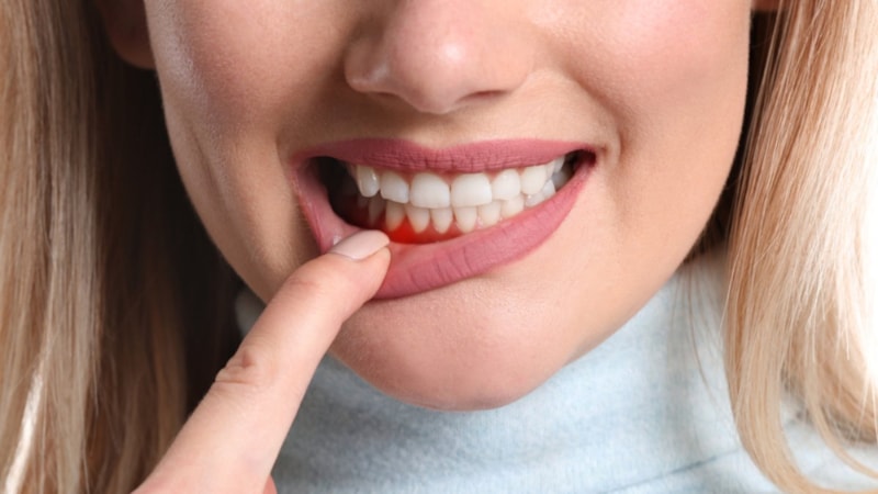 Diş eti kanaması deyip geçmeyin! Gizli seyreden o hastalığın ilk belirtisi olabilir