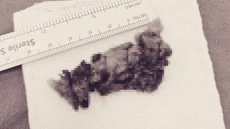 Yozgat'ta bir hastanın burnundan 8 santimetrelik kitle çıktı