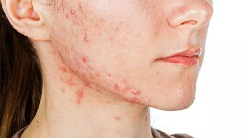 Meğer akne ve sivilcelerin çözümü onda saklıymış! Magnezyum eksikliği belirtileri neler?