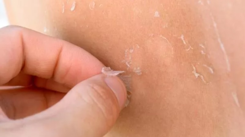 Cilt soyulmasının sebepleri nelerdir? Cilt soyulması nasıl geçer?