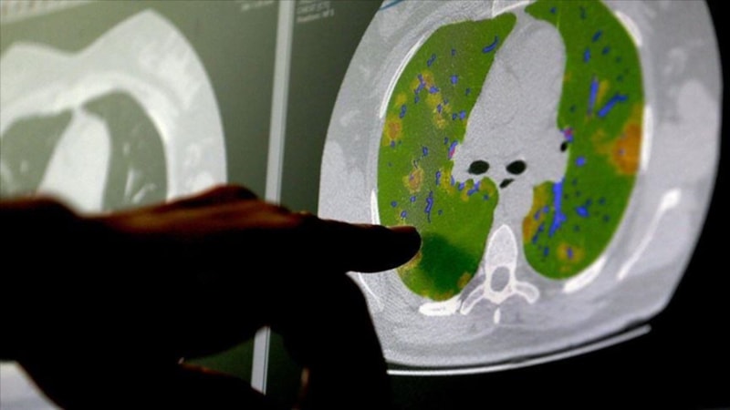 Koronavirüsün beyin hücreleriyle birleşebildiği kanıtlandı