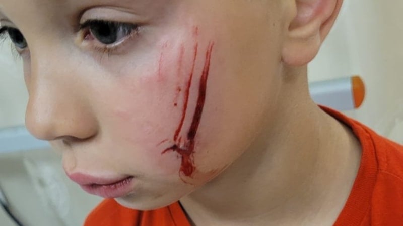 Bursa'da başıboş köpekler 7 yaşındaki çocuğa saldırdı