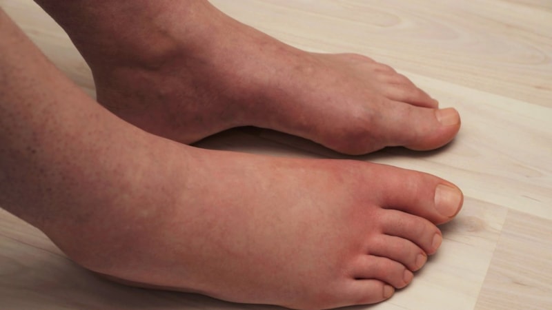 Ödem sanmayın! Ayaklar şişiyorsa dikkat...