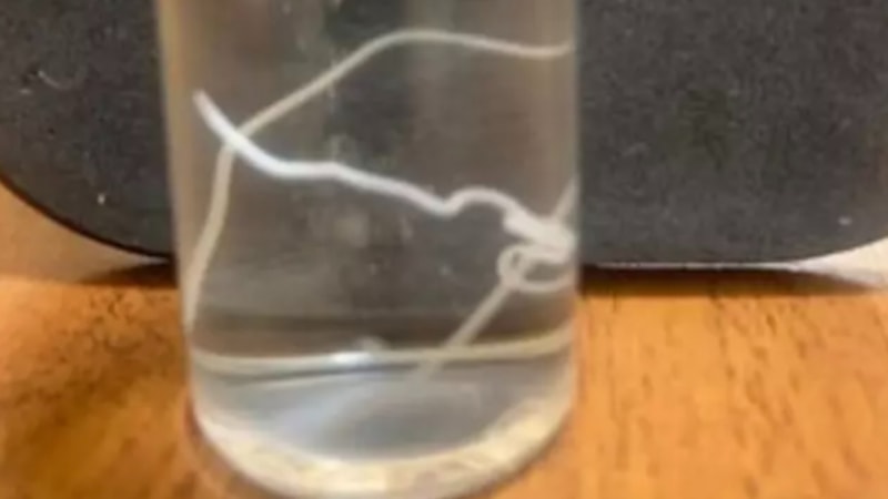 Rusya'da alnından 15 santimetrelik solucan çıktı