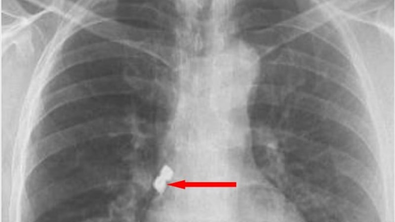 Afyonkarahisar'da tedavi sırasında implant dişleri soluk borusuna kaçtı