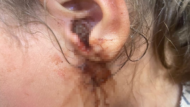 Bitlis'te küçük kızın dış kulak yolundan 23 adet kurtçuk çıkartıldı