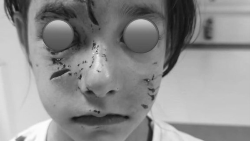 İstanbul'da sitenin bahçesinde oynayan çocuğa köpek saldırısı