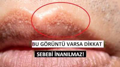 Dudaktaki minik beyaz noktaların gizemi çözüldü!