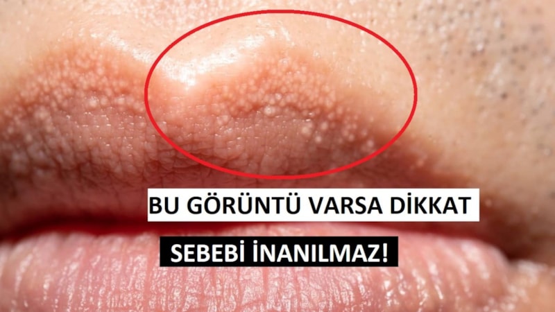 Dudaktaki minik beyaz noktaların gizemi çözüldü!