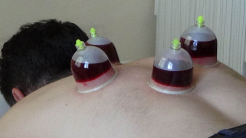 Ekim ayı hacamat günleri: Hangi günler hacamat sünnettir? Hacamat takvimi 2023