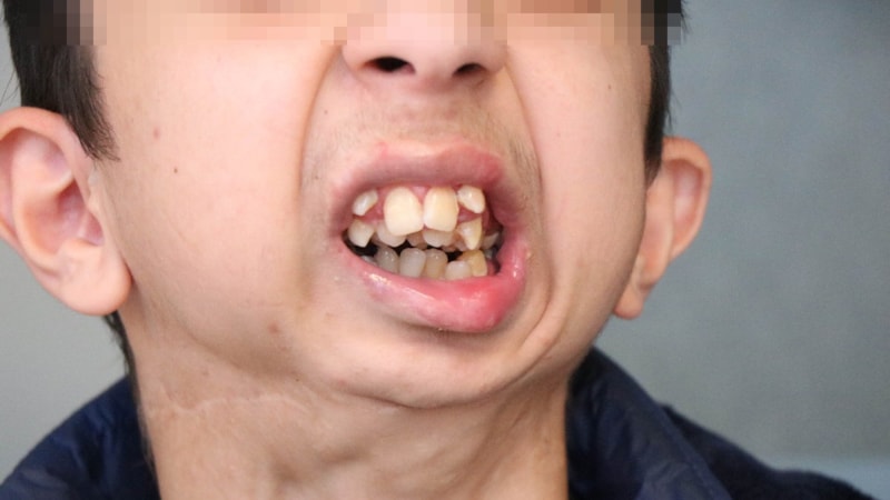 Samsun'da kemik problemleri yaşıyor! Alt çenesi yok...