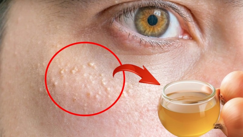 Yağ bezeleri tarih oluyor! Günde iki kez için, etkisini görün