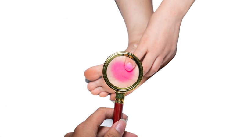 Taban ağrısının sebepleri! Topuk dikenine karşı obezite ve yanlış ayakkabıya dikkat...