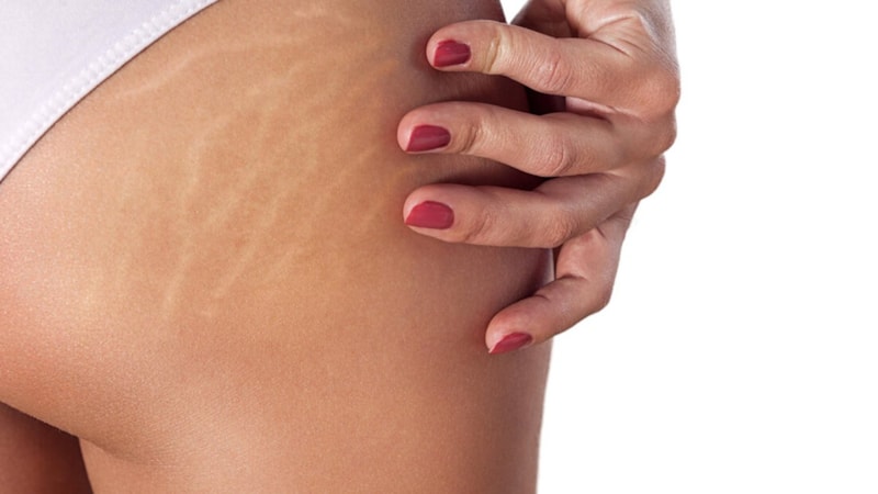 Ciltteki çatlaklara elveda deme zamanı! Bu yöntem ile pürüzsüz olacaksınız...