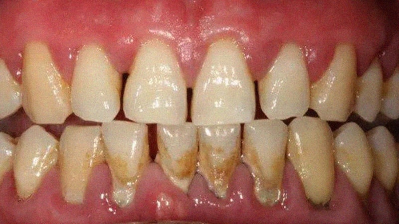 Ağzınızı açmaktan utanmayın! Kimse sizden uzaklaşmayacak...