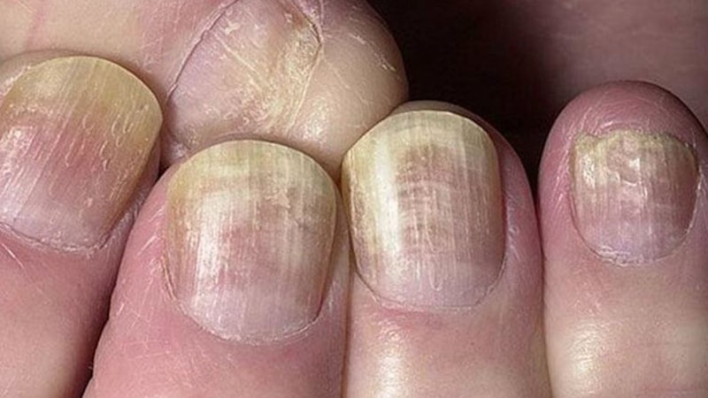 Tırnaklarınız uyarıyor! Eğer tırnaklarınızda bunlar varsa hasta olabilirsiniz...