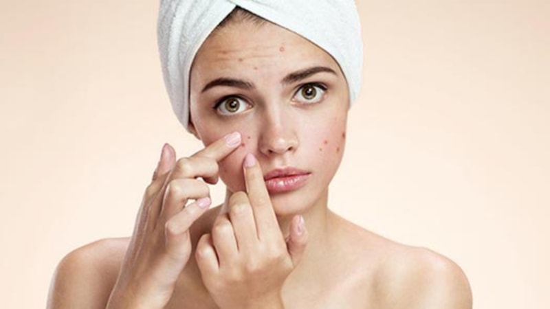 Sivilceye neden olan etkenler nelerdir? Sivilce tedavisi nasıl yapılır?