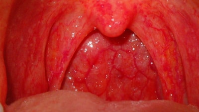 HIV'den kansere kadar birçok hastalığın habercisi! Boğaz yanmasını hafife almayın
