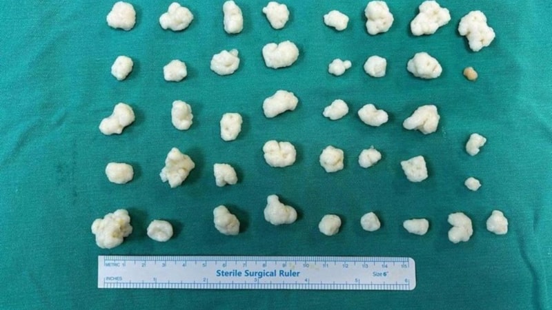 Düzce'de ameliyatta çıkanlar şaşırttı! Hastanın dizinden 41 eklem faresi alındı