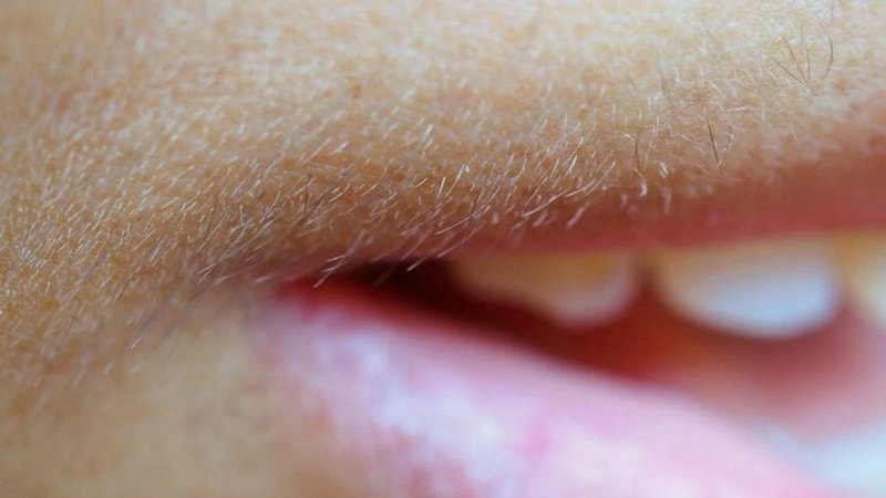 Şekerli limonu yüzünüze sürün, kalıcı olarak kurtulun..