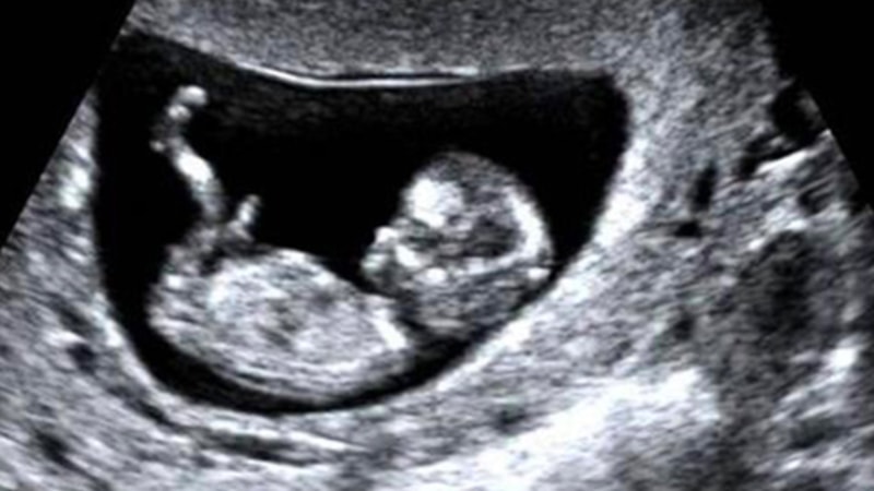 İtalya'da ilginç olay! Erkek olmak için ameliyata giren transın hamile olduğu ortaya çıktı...