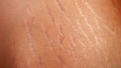 Çatlak izlerinize sürün, eski halinize dönün...