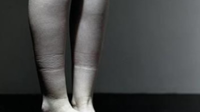 Ayak bileğinde iz oluşanlar dikkat! Çoraplarınızın bıraktığı izler hiçte masum değil…