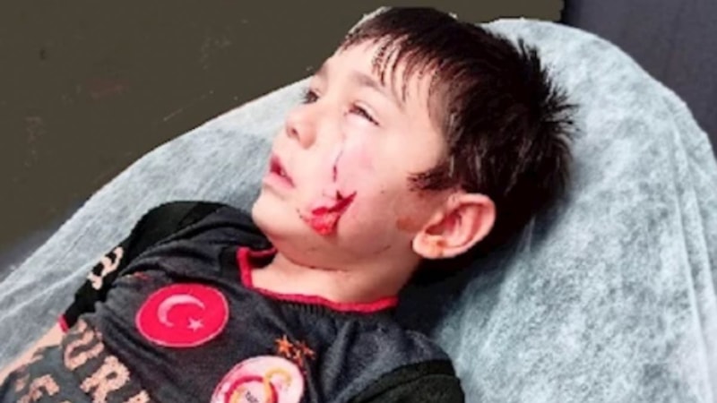 CHP'li Bandırma Belediye Başkanı'nın pitbull köpeği küçük çocuğa saldırdı