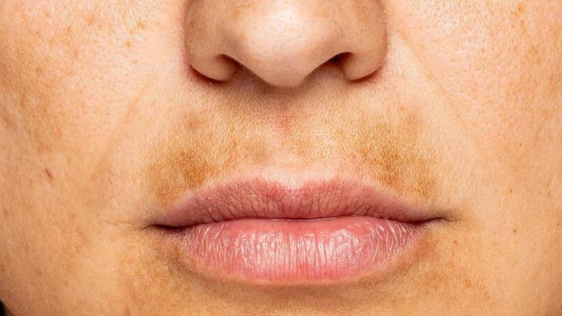 Suyunu sıkıp sürün, dudak üstünüzdeki kararmalara son verin...