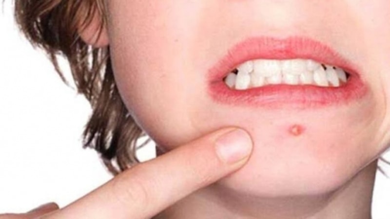 Sivilce neden çıkar? Sivilce oluşumuna sebep olan etkenler nelerdir?