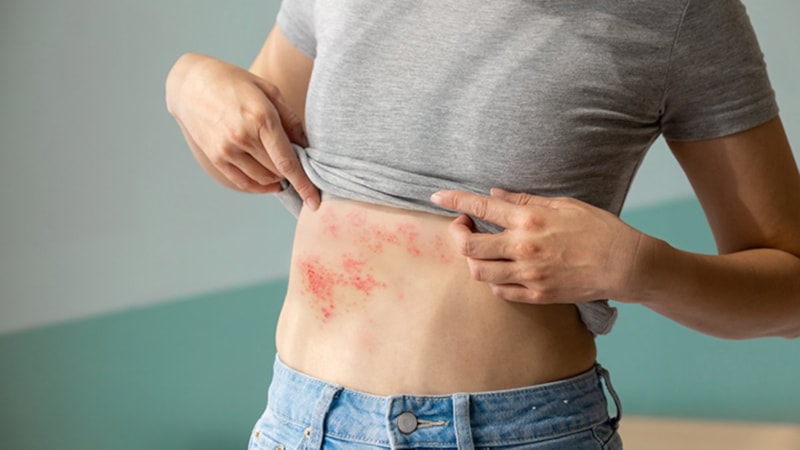 Zona hastalığı nedir? Zona hastalığı tedavisi nedir?