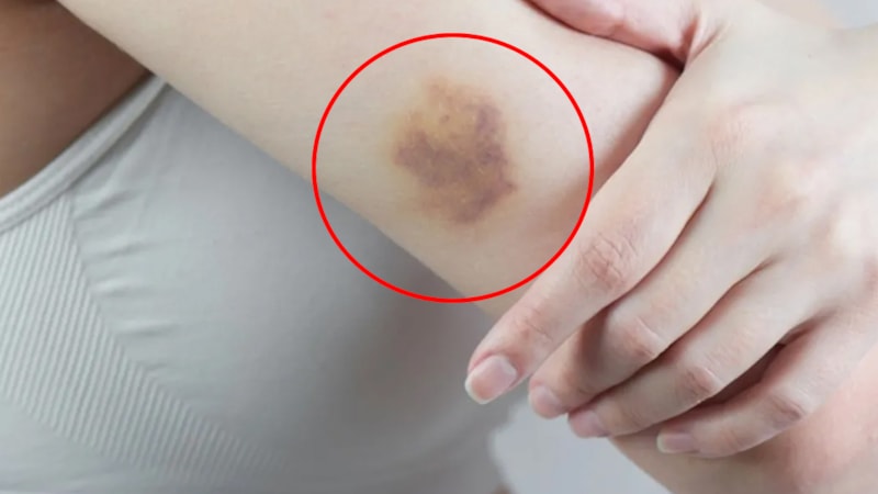 Görmezden gelmeyin! Vücuttaki bu morarmaların sebebi bakın neymiş