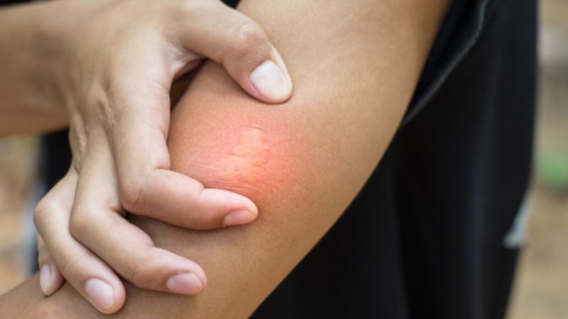 Sivrisinek ısırığının üzerine ondan sürün, ne kaşıntı kalsın ne iz…