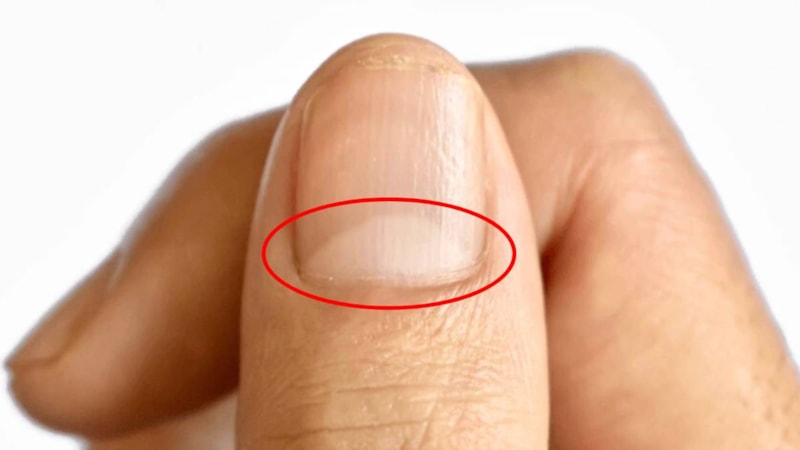 Tırnak diplerine dikkat! Eğer öyleyse bakın hangi hastalıkların habercisiymiş…