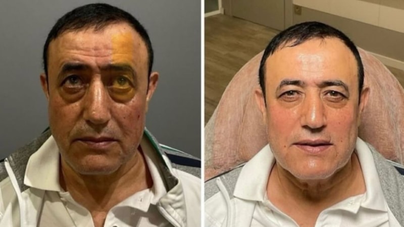 Mahmut Tuncer estetik yaptırdı