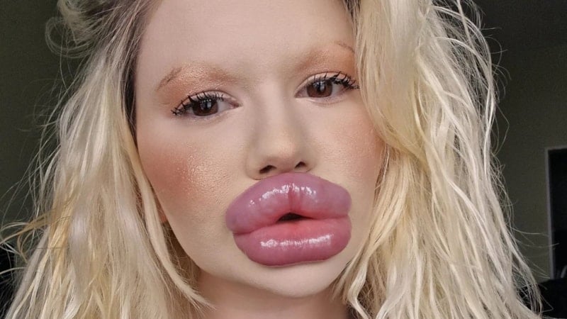 32 estetik geçirdi: Dünyanın en büyük dudaklarına sahip...