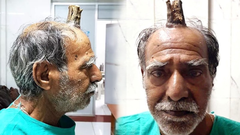 Tarlada kafasını vurdu, yıllar içinde boynuzu çıktı! Boynuzlu adamı görenler inanamadı…