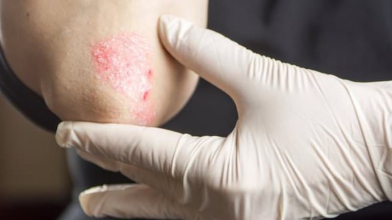 Sedef hastalığı için hangi doktora gidilir? Sedef hastalığına hangi bölüm bakar?