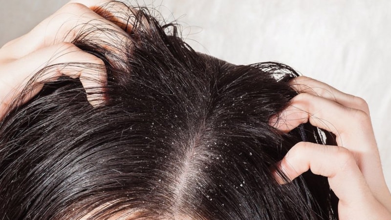 O sabunu kullanan yaşıyor, ne egzama ne de kepek bırakıyor…