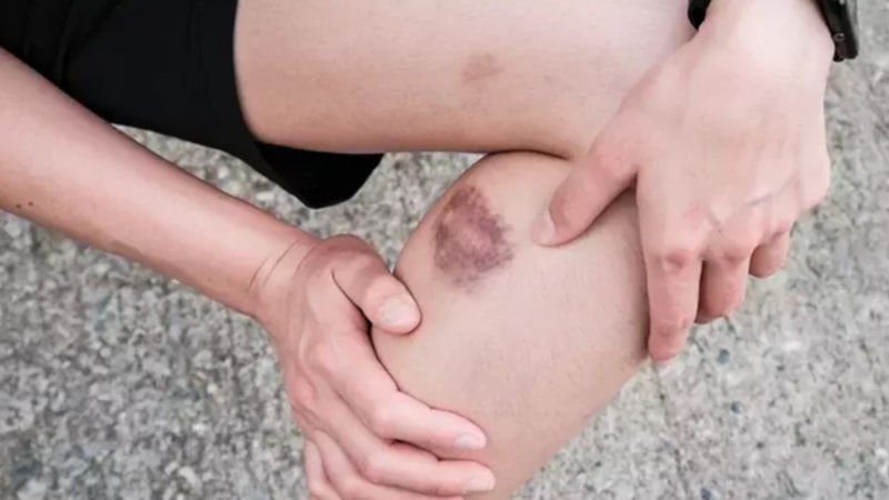 Kol ve bacakları çabuk moraranlar dikkat! Meğer o hastalığın habercisiymiş…