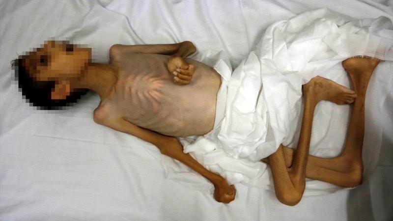 Gazze'de açlıktan ölenlerin sayısı 40'a yükseldi