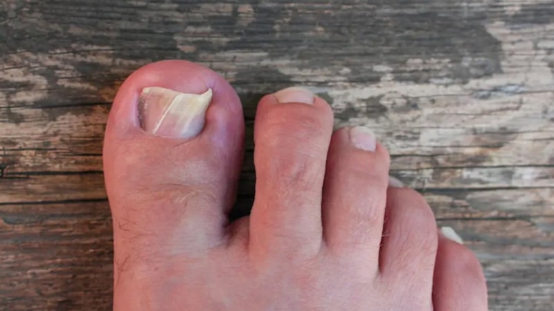 Tırnak batığınıza o yöntemi uygulayın, batıklar tek hamlede nasıl çıkıyor görün…