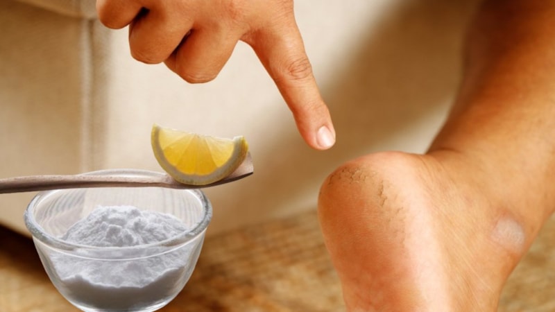 Evde kolay çözüm: Limon suyu ile karıştırıp sürün, ayak nasırına 1 günde veda edin